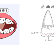 孩子换牙新长的门牙呈锯齿状，这正常吗