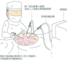 胃镜、肠镜、腹腔镜：探索身体深处的“望远镜”