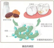 如何通过涂氟预防宝宝蛀牙