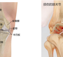 换了人工关节，我能不能成为“钢铁侠” （膝关节篇）