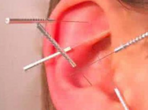耳针刺激方法