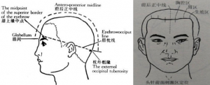 焦氏头针