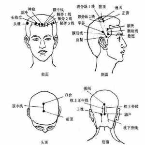 国际头针标准线