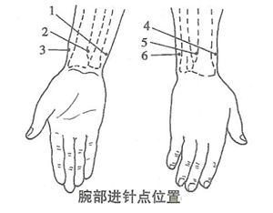 腕踝针进针点及其适应证