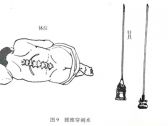 常用急救诊疗技术●穿刺术●腰椎穿刺术