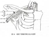 常用急救诊疗技术●穿刺术●锁骨下静脉穿刺术