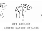 骨折·上肢骨折·肱骨外科颈骨折