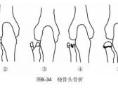 骨折·上肢骨折·桡骨头骨折