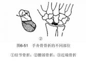 骨折·上肢骨折·手舟骨骨折