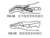 骨折·上肢骨折·指骨骨折