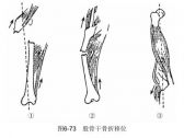 骨折·下肢骨折·股骨干骨折