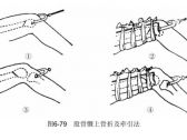 骨折·下肢骨折·股骨髁上骨折