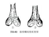 骨折·下肢骨折·股骨髁间骨折