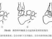 骨折·下肢骨折·距骨骨折