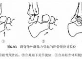 骨折·下肢骨折·距骨骨折