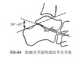 骨折·下肢骨折·跟骨骨折