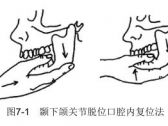 脱位·颞下颌关节脱位