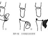 脱位·上肢脱位·月骨脱位