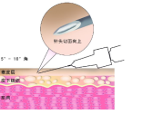 预防接种工作规范（2023年版）·（附件5—6）疫苗接种方法